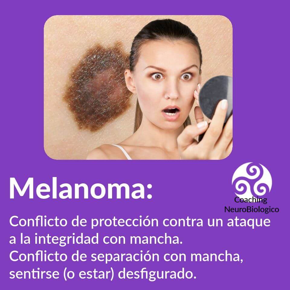 melanoma