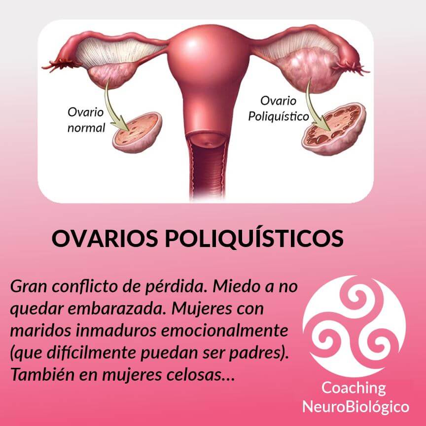 ovarios poliquisticos