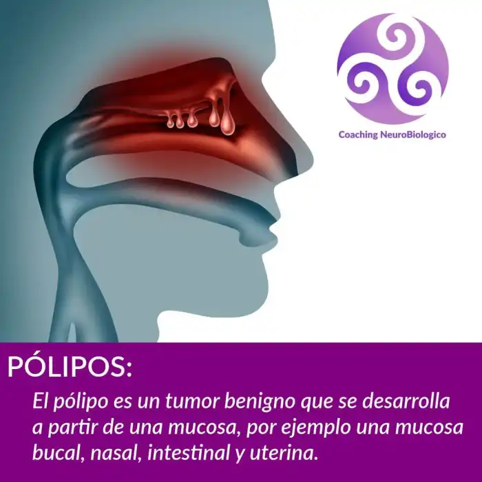 polipo-tumor-benigno