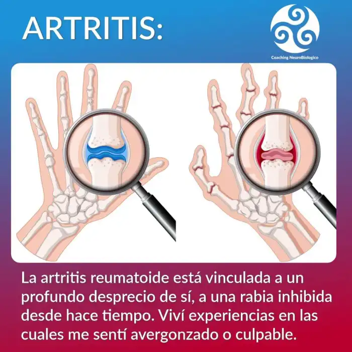 artritis reumatoidea