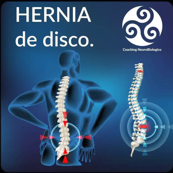 hernia-de-disco