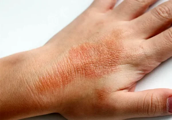 Biodescodificación de la dermatitis de contacto