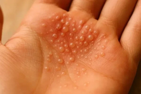 Biodescodificación de la dermatitis dishidrótica