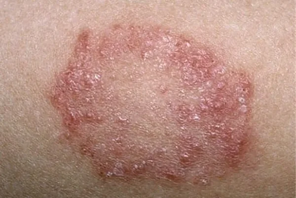 Biodescodificación de la dermatitis numular