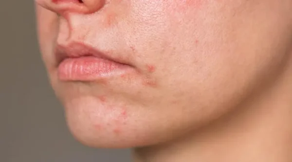 Biodescodificación de la dermatitis perioral