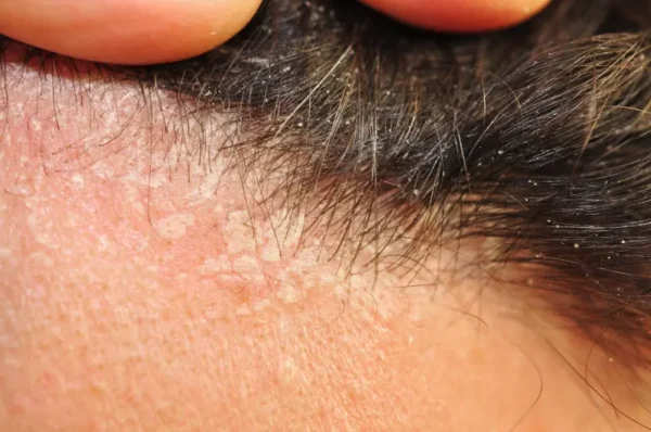 Biodescodificación de la dermatitis seborreica
