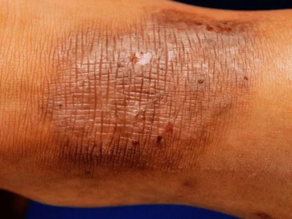 Biodescodificación de la neurodermatitis